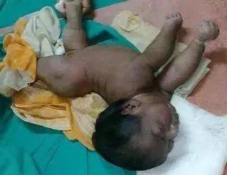 破伤风三个征兆